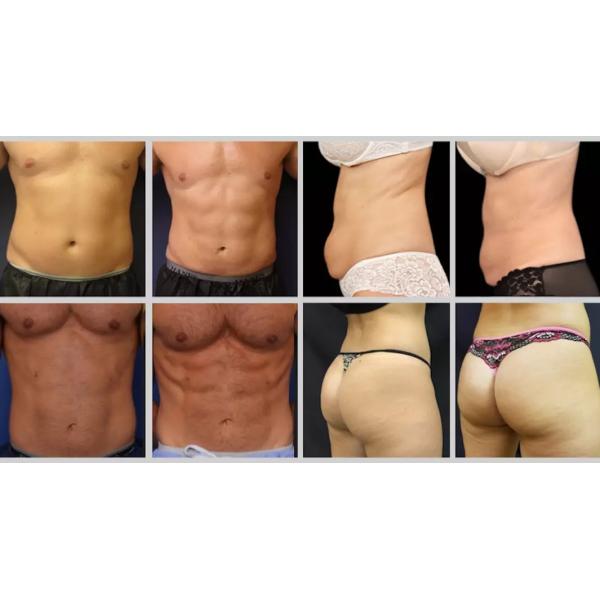 Portable 7 Tesla Ems Muscle Stimulator Body EMShapeing Hi Neo Emt Machine