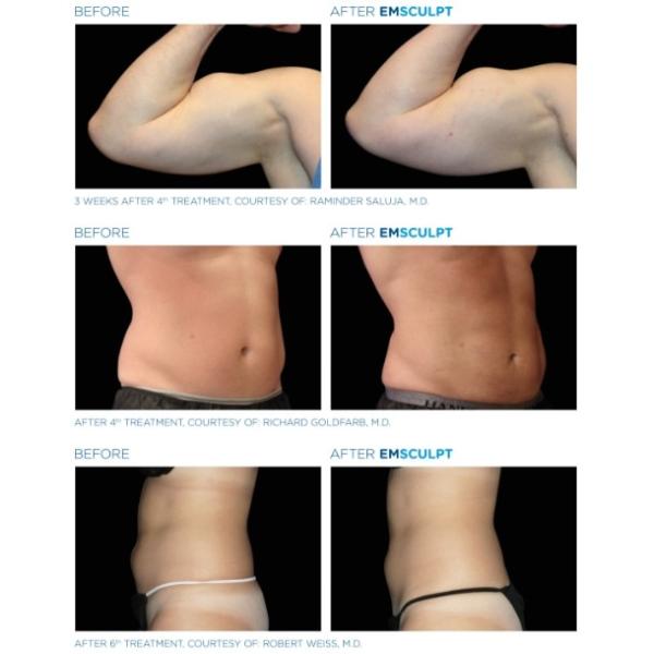 Muscle Build Skin Tightening EMS EMShapeing Machine