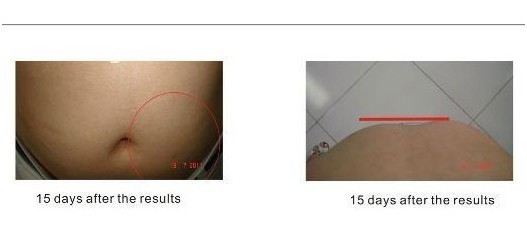 2 In 1 Cold Laser / Ultrasonic Cavitation Slimming Machine System