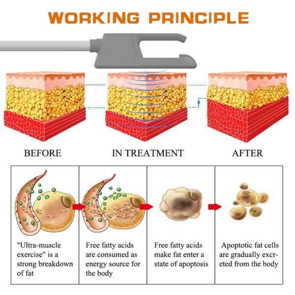 Portable 7 Tesla Ems Muscle Stimulator Body EMShapeing Hi Neo Emt Machine