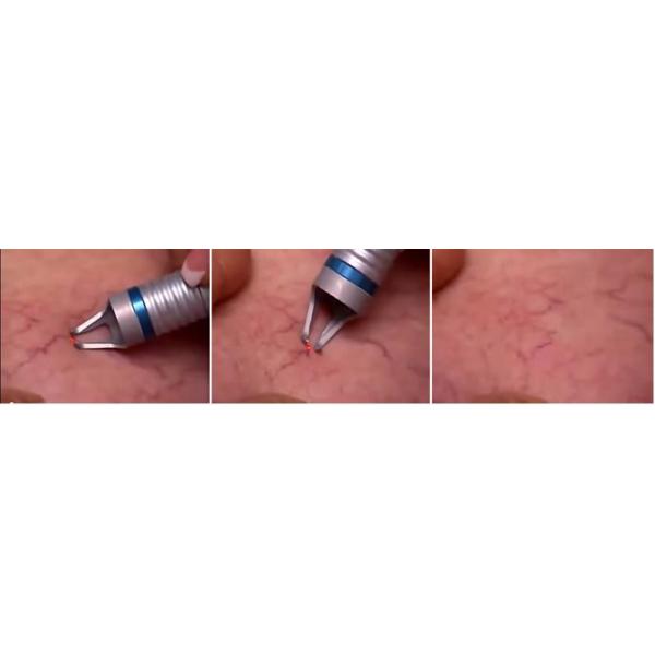 high frequency 980nm diode laser vascular removal machine for sale