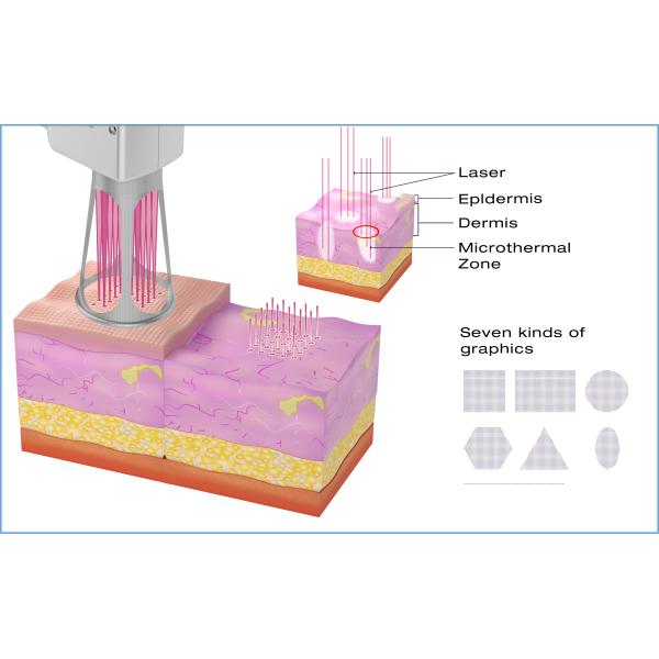 Air Cooling CO2 Fractional Laser Machine For Vaginal Tightening