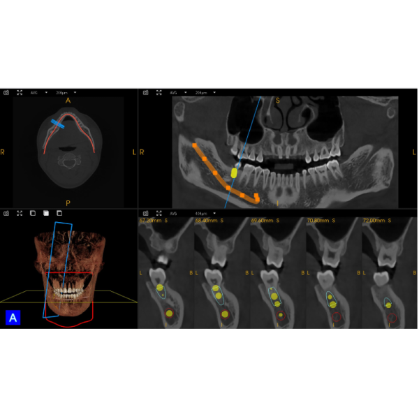 Dental Implant Orthodontic CBCT System High-Resolution 3D Imaging for Precise Diagnosis