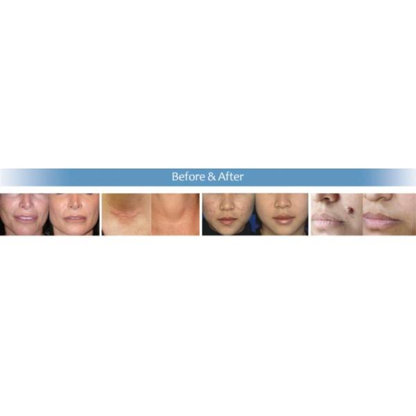 Vertical Design Rf Co2 Fractional Laser Machine With Vaginal Tightening Function