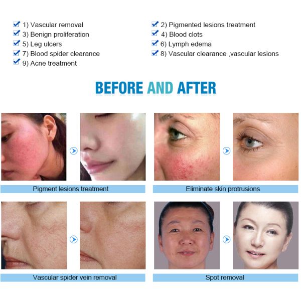980nm Facial Thread Vein Removal Machine Diode Laser Vascular Therapy Device
