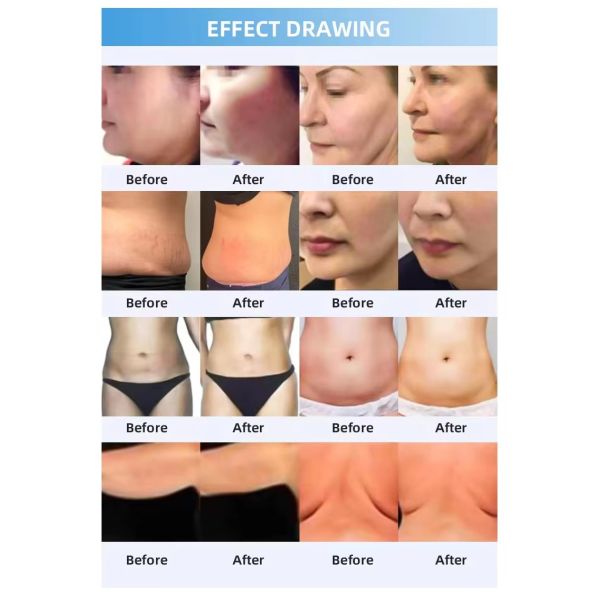 2 IN 1 Cryo Fat Freezing Machine