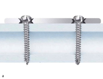 Ulna Radius Dcp Dynamic Compression Plate Ortho Class IIb