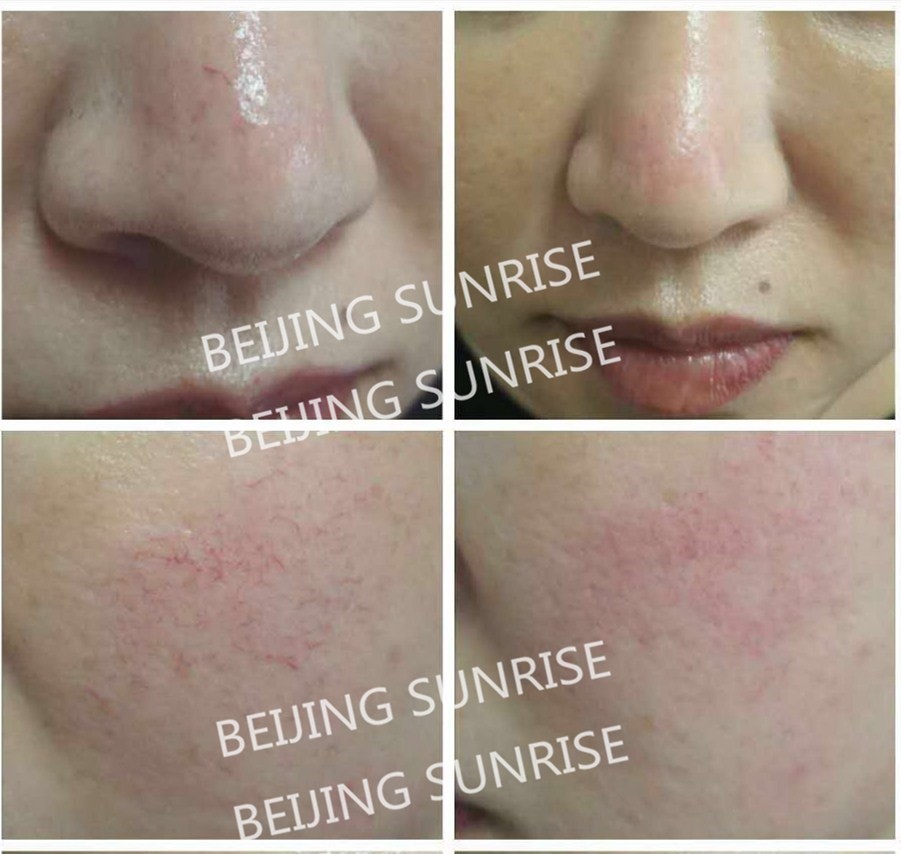 vascular removal 980nm spider vein medical use no pain diode laser 980