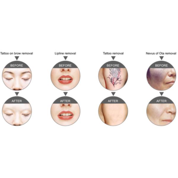 Portable Nd Yag Laser Remove Tattoos