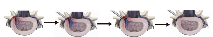 RF Surgical Spine Probe for Precise Disc Compression and Decompression