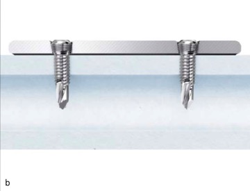 Ulna Radius Dcp Dynamic Compression Plate Ortho Class IIb