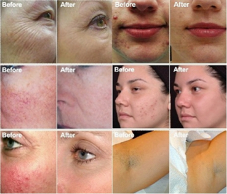 Wrinkle Removal E Light IPL RF System 7.4 Inch Color Touch LED Screen