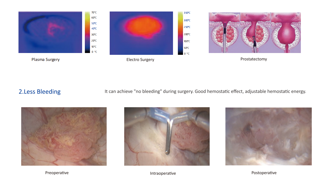 Disposable Radio Frequency Plasma Generator Probe for TURP